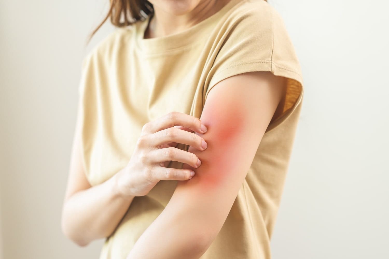 Крапивница